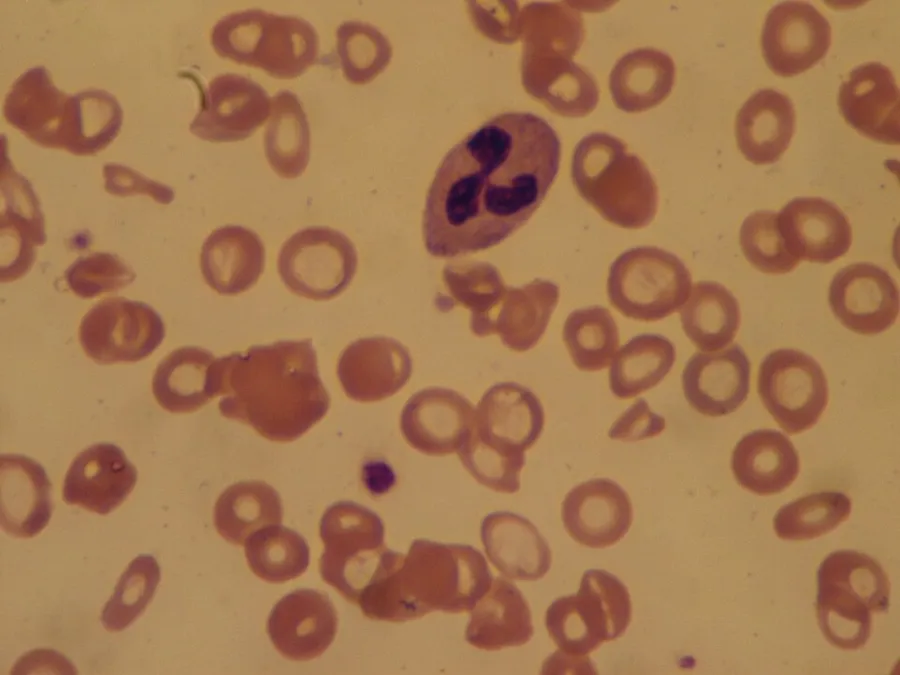 Blood smear of a patient with Iron deficiency anemia at 40x enhancement