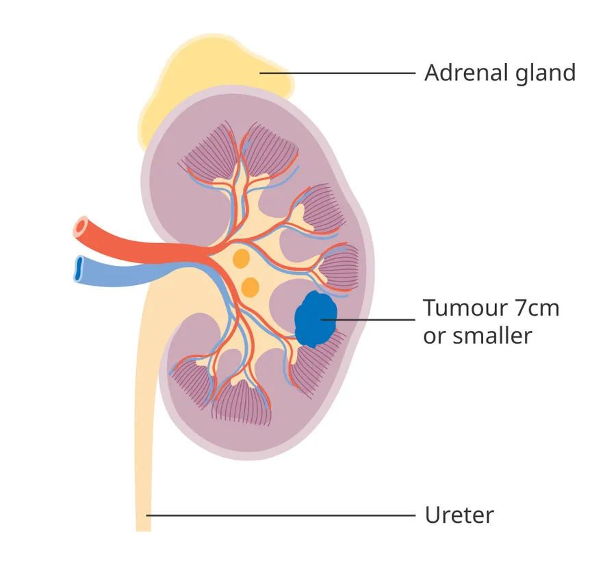 Diagram showing stage 1 kidney cancer.