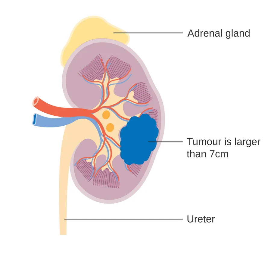 Diagram showing stage 2 kidney cancer.