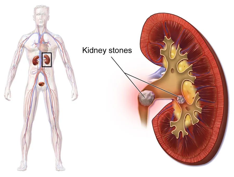 Kidney Stones.