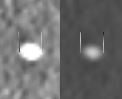 Measurement of a kidney stone in a CT window for soft tissue (width of 400 HU, center at 50 HU) and bone window (W1800,C400). The kidney stone was directly measured outside the body to be 5.6 mm, and is here seen after p