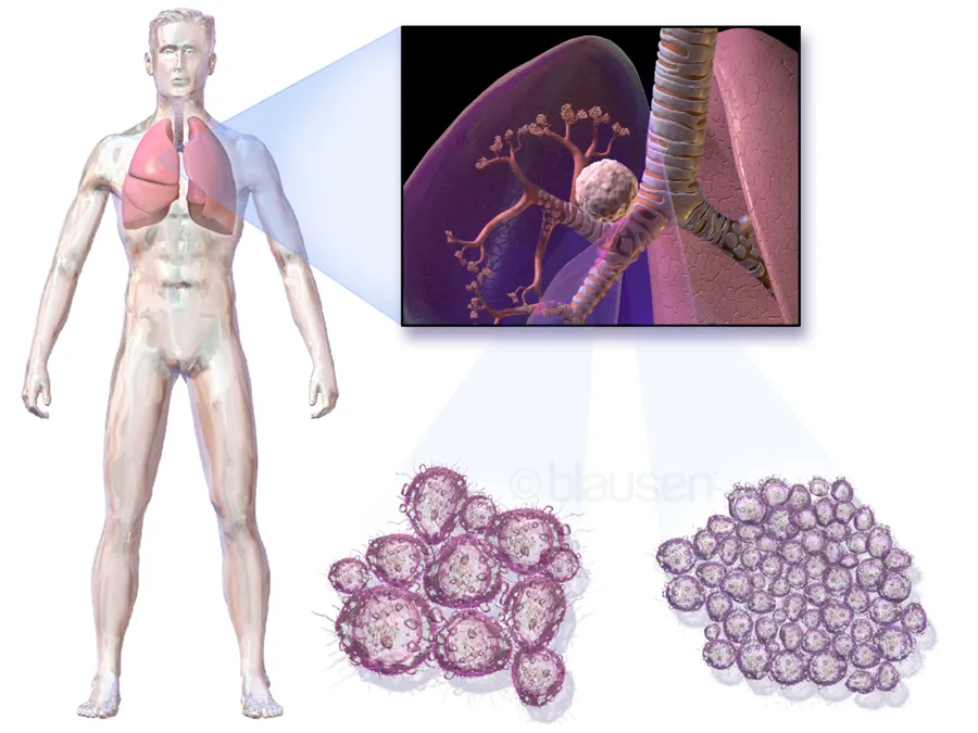 Lung Cancer.