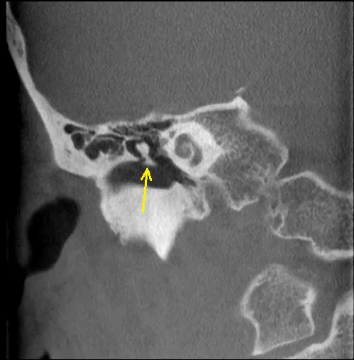 Coronal Section of right Tempoporal bone. A yellow arrow shows a malleus.
