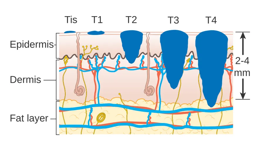 Diagram showing the T stages of melanoma.