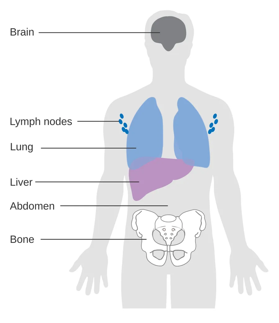 Diagram showing the most common places for melanoma to spread to.