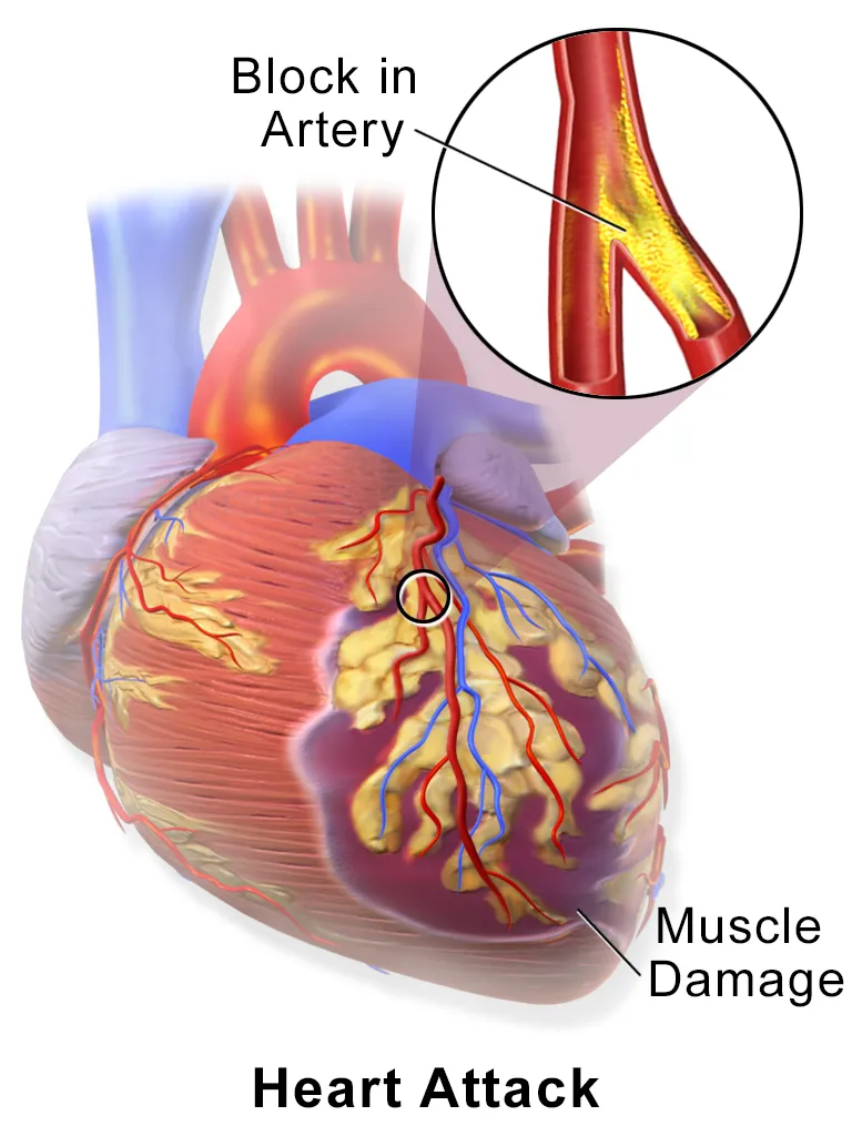 Myocardial Infarction or Heart Attack.