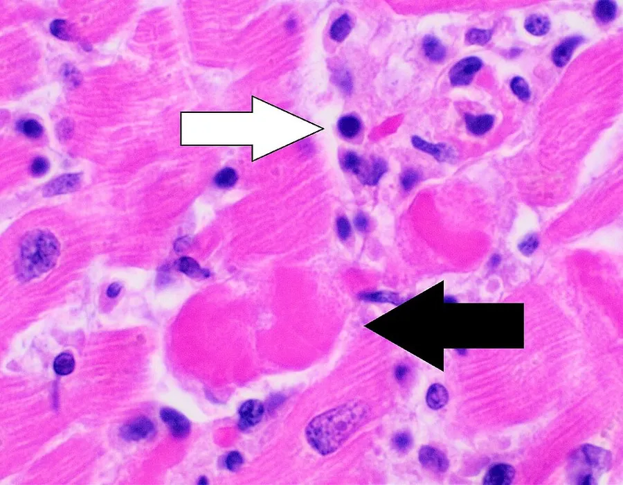 Histopathology of lymphocytic myocarditis (white arrow points to a lymphocyte), commonly showing myocyte necrosis (black arrow), seen as hypereosinophilic cytoplasm with loss of striations. H&E stain.