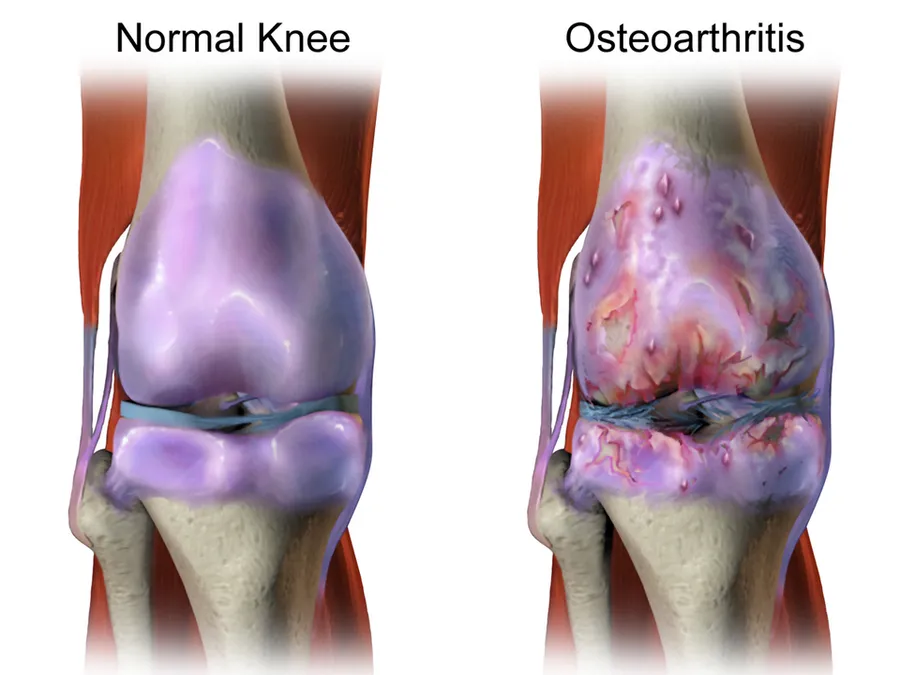 Osteoarthritis.