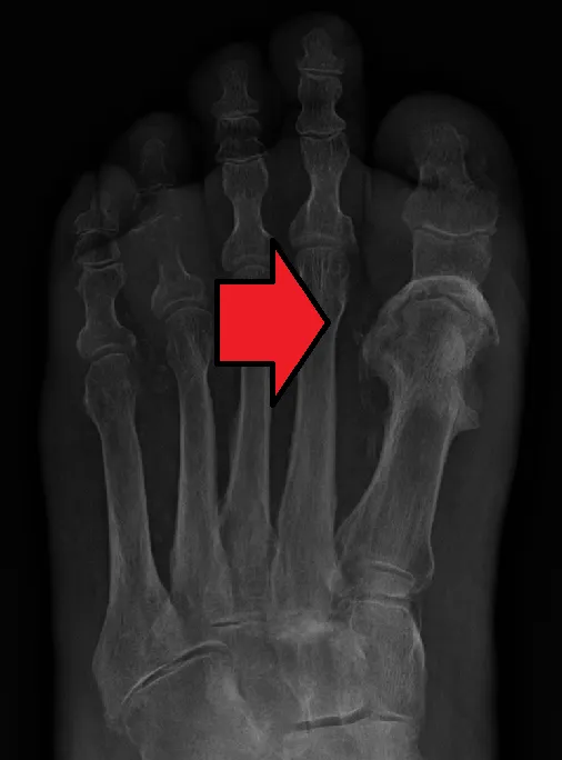 Osteomyelitis of the 1st toe