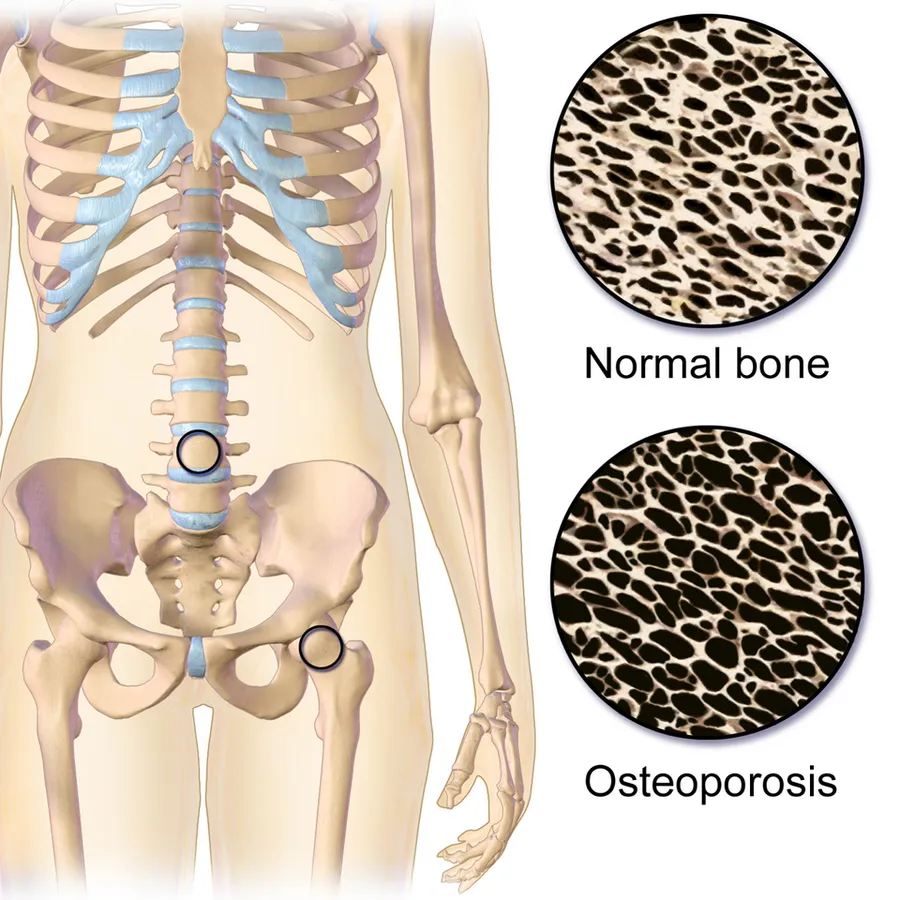 Osteoporosis Locations. Animation in the reference.[1] This image was donated by Blausen Medical.