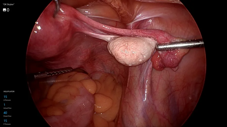 Right ovary