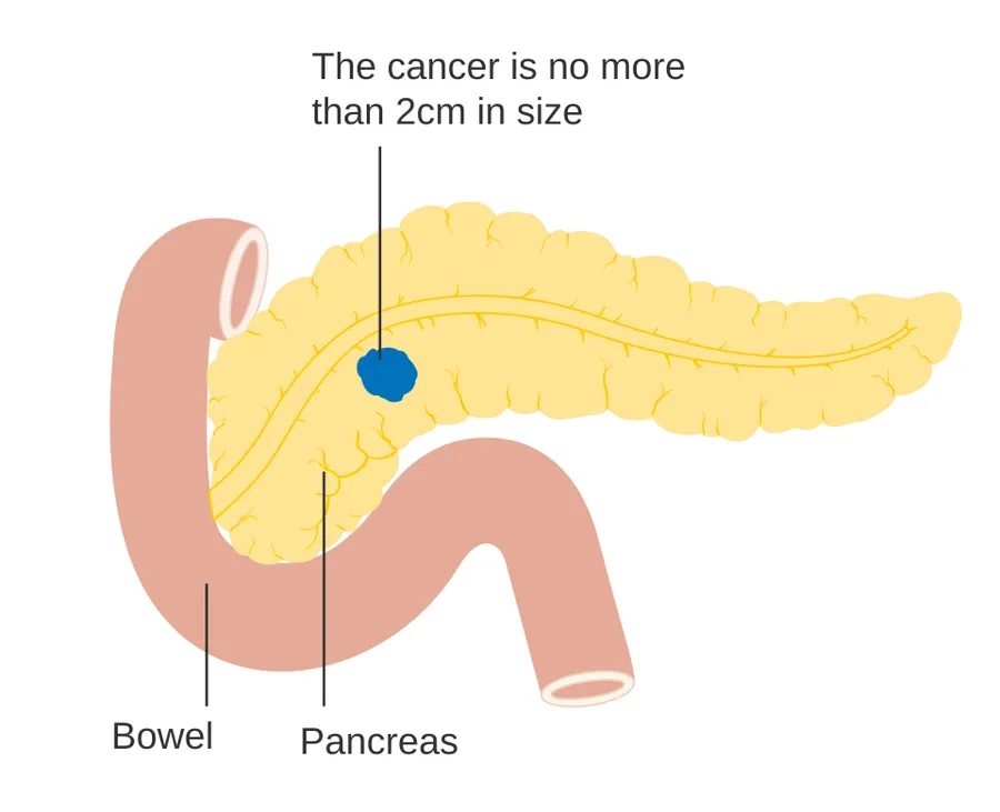Diagram showing stage T1 cancer of the pancreas.