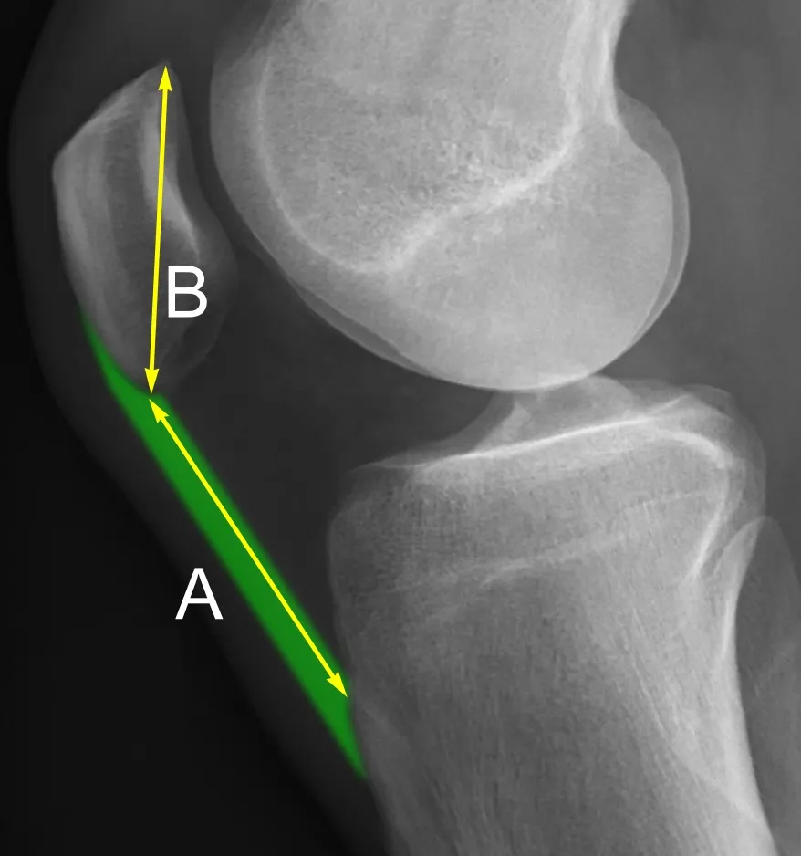 Lateral X-ray of a normal knee, with Insall-Salvati ratio, calculated as the patellar tendon length (A) divided by the patellar bone length (B). It indicates patella baja when < 0.8. Douglas Dennis (2017-02-25). TKA i