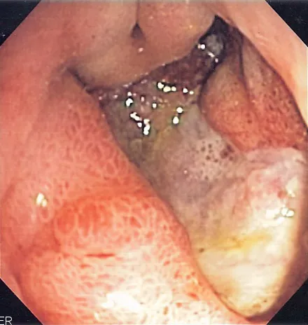 A peptic ulcer may accompany gastritis.Endoscopic image of deep gastric ulcer in the gastric antrum.