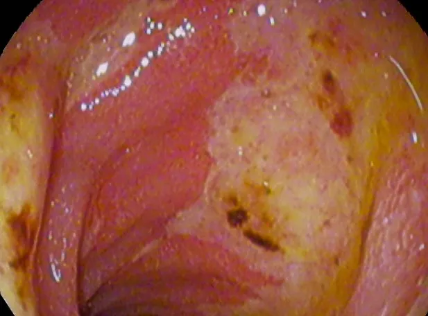 Duodenal ulcer or Acute Duodenal Mucosal Lesion, 20 y.o, male, Indonesian.