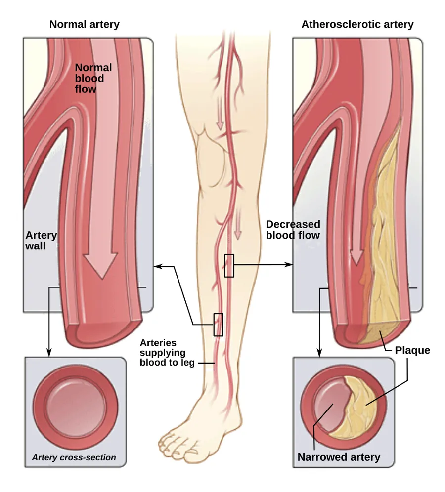 The illustration shows how P.A.D. can affect arteries in the legs. Left figure shows a normal artery with normal blood flow. The inset image shows a cross-section of the normal artery. Right figure shows an artery with p