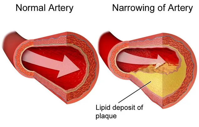 This is an example of how build up of lipids (fat) in the artery prevents blood from flowing.