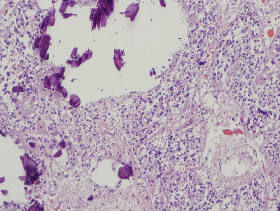 Pineal gland with calcifications