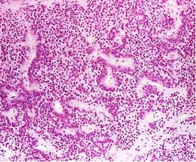 Histopathology of a true null cell adenoma. True null cell adenomas are composed of uniform, mildly atypical cells with chromophobic cytoplasm. This example shows sinusoidal, papillary, and pseudopapillary architecture s