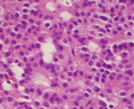 Histopathology of a silent gonadotroph pituitary adenoma which is in this case is eosinophilic (contrary to normal, basophilic, gonadotroph cells)