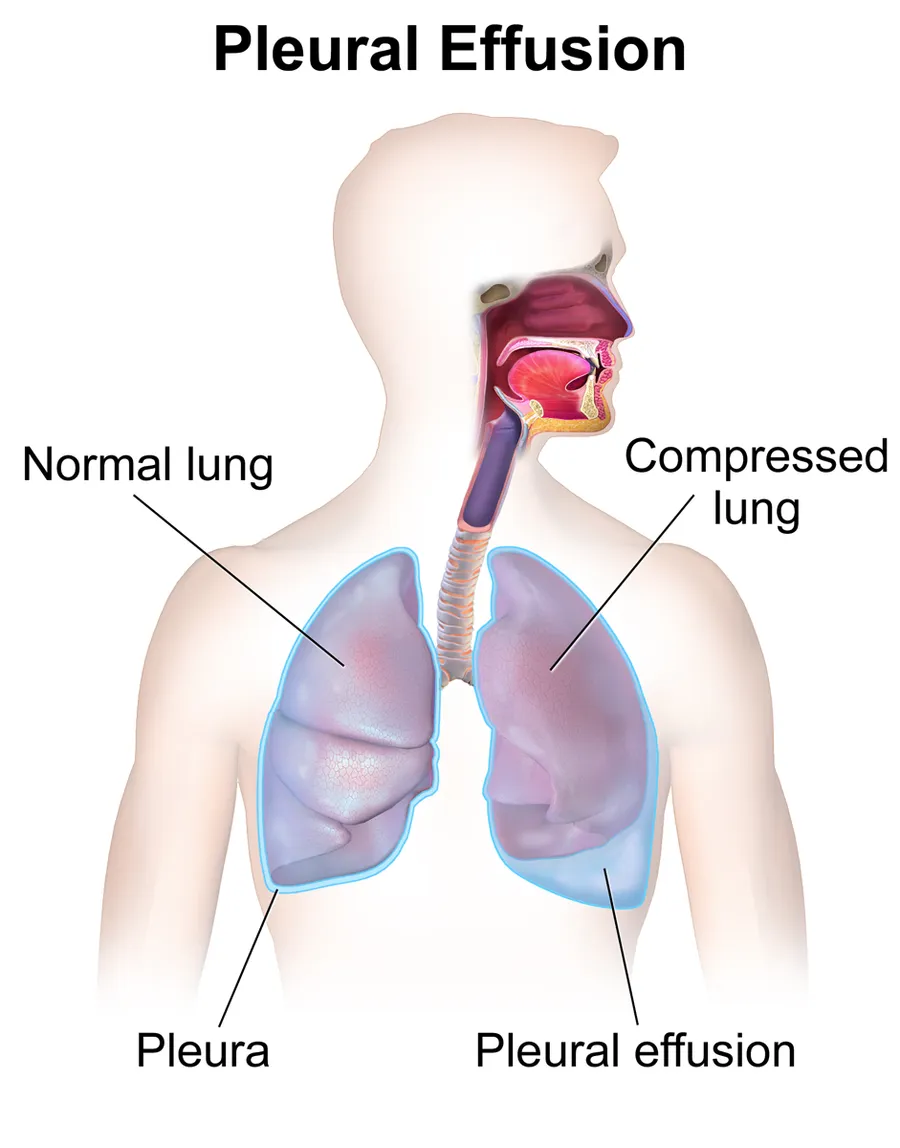 Pleural Effusion.