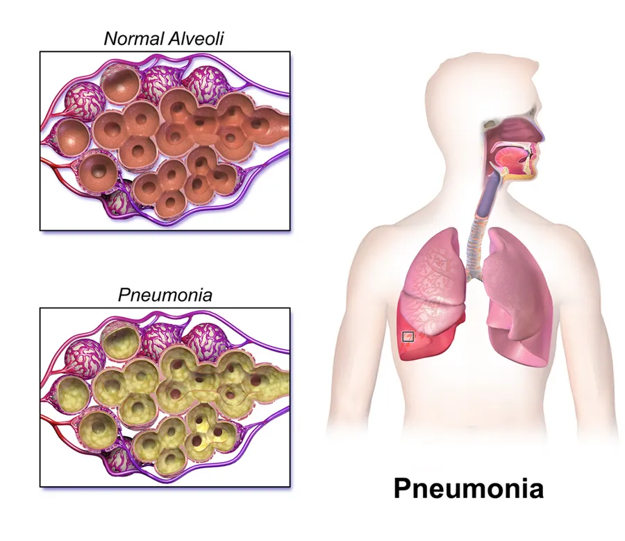 Pneumonia.