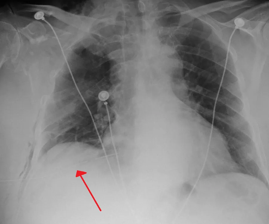 A chest tube placed on the right for a pneumothorax