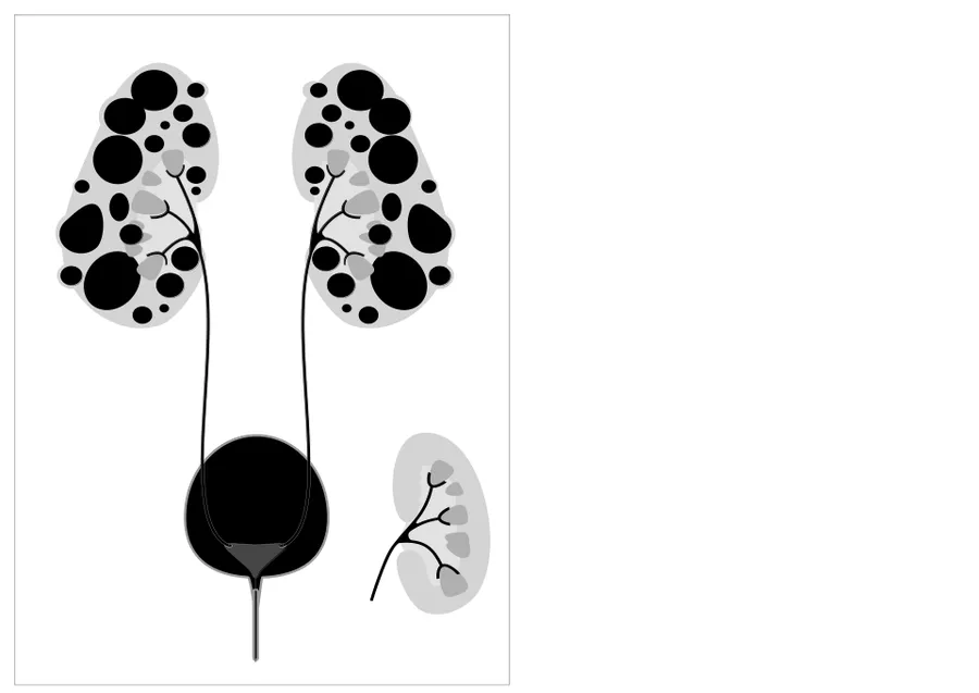Autosomal dominant polycystic kidney disease with normal kidney inset to right of diagram