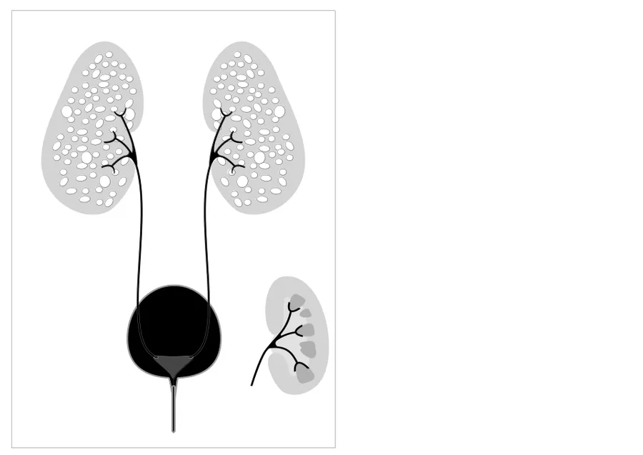 Autosomal recessive polycystic kidney disease with normal kidney inset to right of diagram