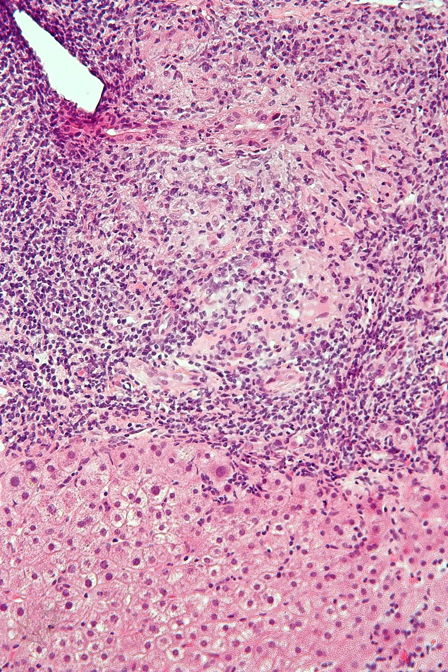 Intermediate magnification micrograph of primary biliary cirrhosis. H&E stain. Features: Bile duct intraepithelial lymphocytes - key feature. Bile duct epithelial cells with eosinophilic cytoplasm. Granulomata - clos