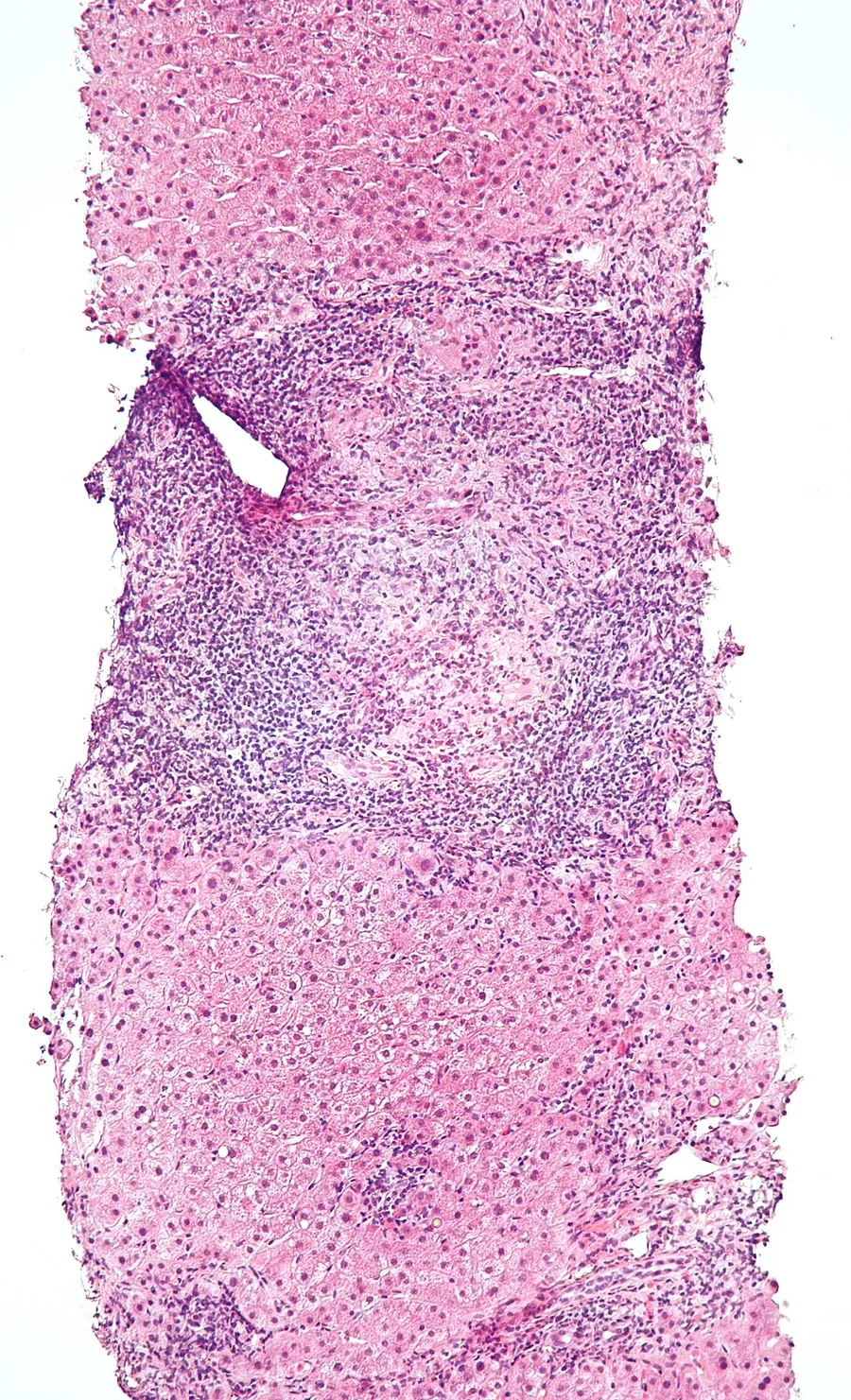 Low magnification micrograph of primary biliary cirrhosis. Liver biopsy. H&E stain. Features: Bile duct intraepithelial lymphocytes - key feature. Bile duct epithelial cells with eosinophilic cytoplasm. Granulomata -
