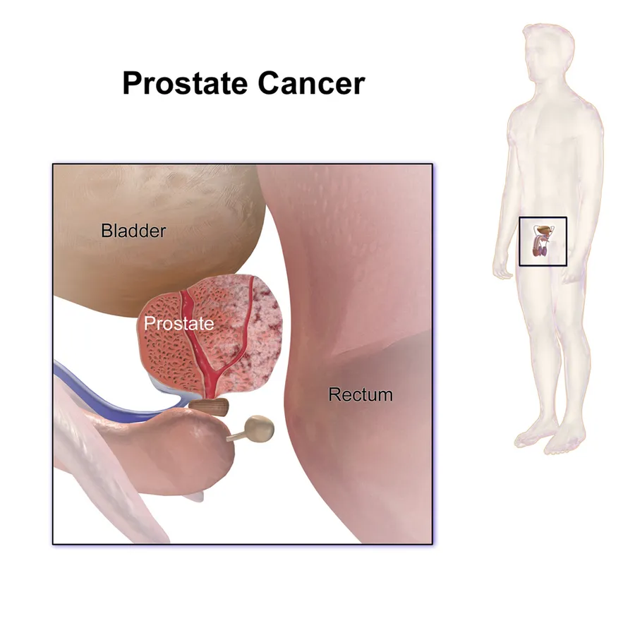 Prostate Cancer.