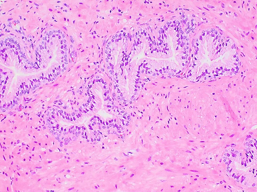 Histology of normal prostate, H&E stain, with benign features: Glands are rounded to irregularly branching, with an inner layer of epithelial cells surrounded by an outer layer of basal cells. They are surrounded by