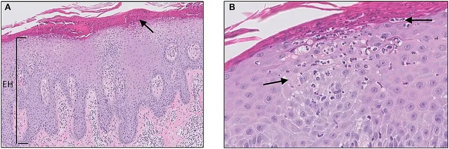 Micrograph of psoriasis vulgaris. Confluent parakeratosis, psoriasiform epidermal hyperplasia [(A), EH], hypogranulosis, and influx of numerous neutrophils in the corneal layer [(A), arrow]. (B) Transepidermal migration