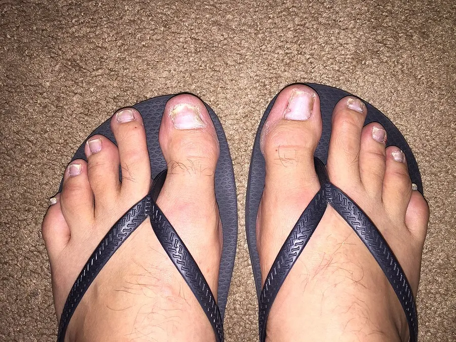 A photograph showing the effects of psoriasis on the toenails.