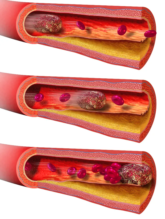Embolism.