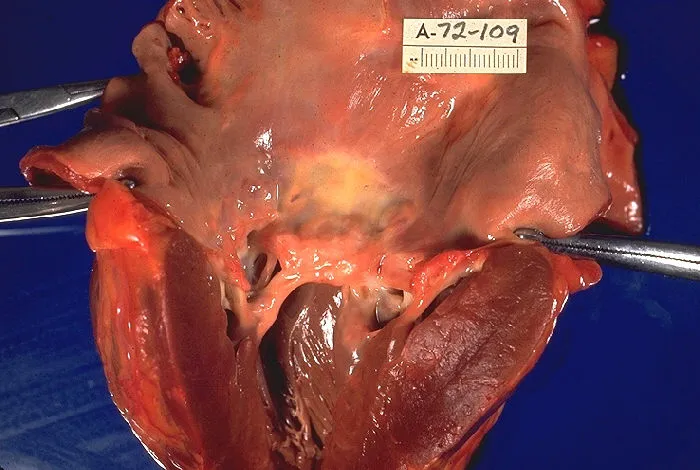 Source says: "Gross pathology of rheumatic heart disease. Left ventricle has been cut open to display characteristic severe thickening of mitral valve, thickened chordae tendineae, and hypertrophied left ventricular myoc