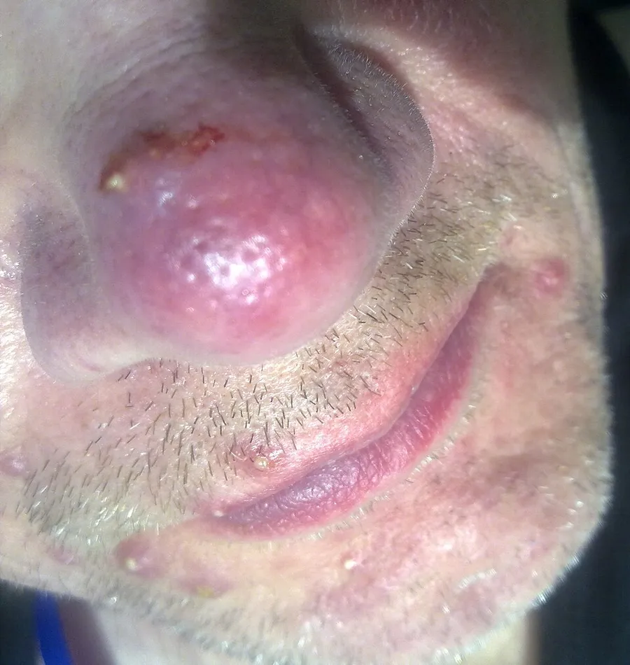 Acne rosacea on face