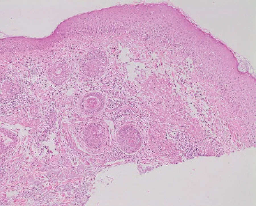 Micrograph of rosacea. A skin biopsy showing rosacea as enlarged, dilated capillaries and venules located in the upper dermis, angulated telangiectasias, perivascular and perifollicular lymphocytic infiltration, and supe