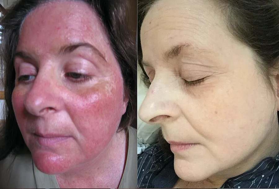 L=Topical Steroid induced Rosacea; R=after steroid withdrawal and photobiomodulation therapy