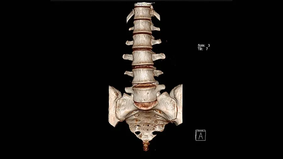 3D volume-rendered (3D reconstruction) CT scan of a normal human lumbar spine and sacrum, shown from an anterior (front) view. Captured at a diagnostic center in Navi Mumbai, Maharashtra, India.