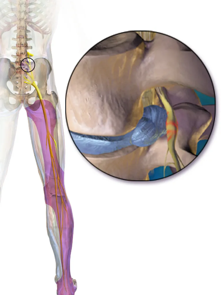 An illustration depicting sciatica.