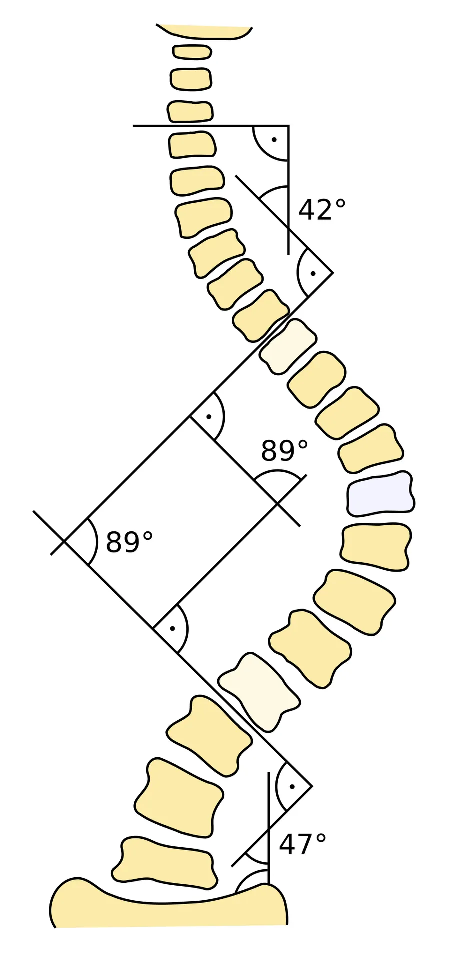 Cobb angle measurement in scoliosis