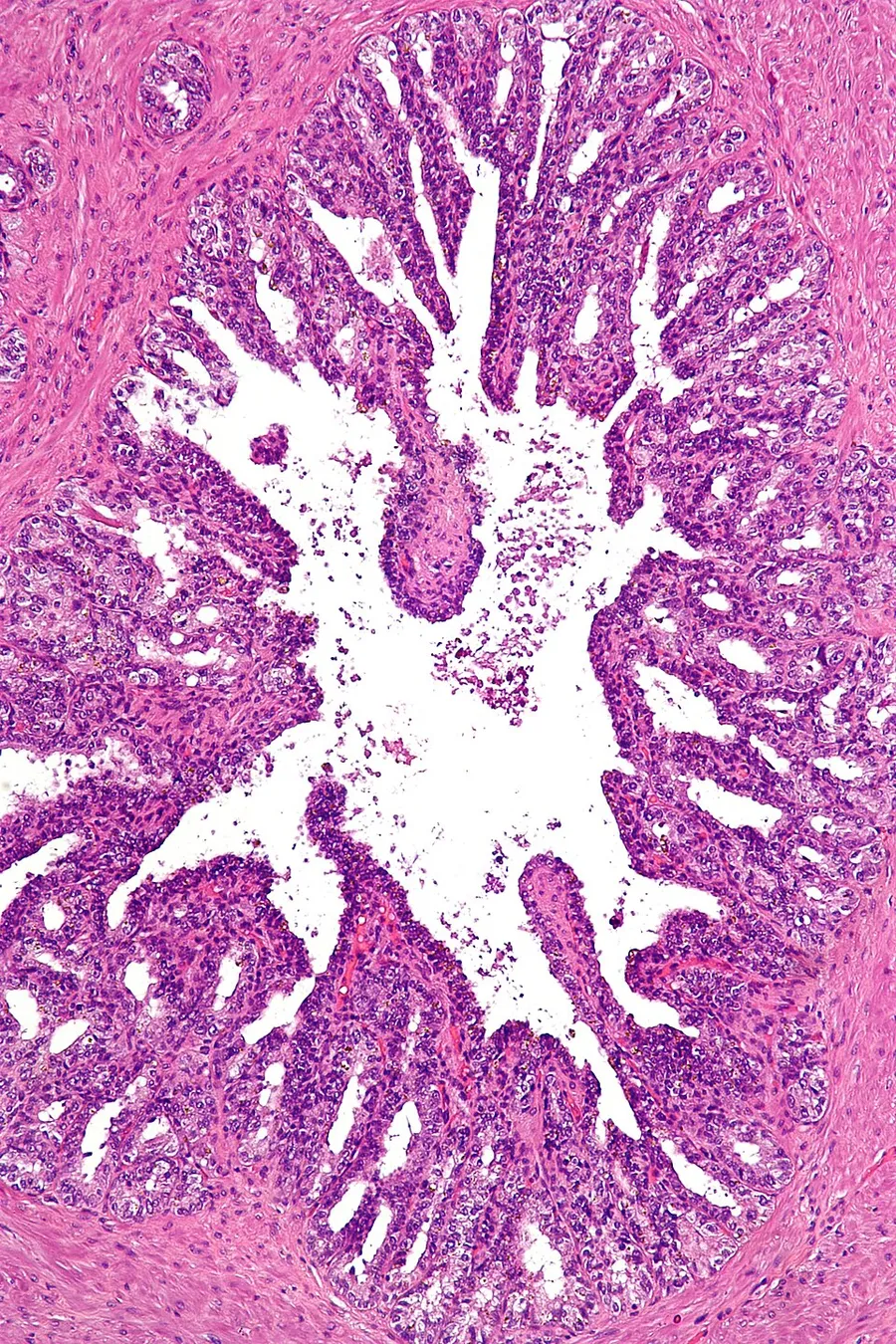Low magnification micrograph of seminal vesicle. H&E stain. Prostatectomy specimen. The epithelium of seminal vesicle is the same as ejaculatory duct.[1] References ↑ Leroy X, Ballereau C, Villers A, et al. (April 20