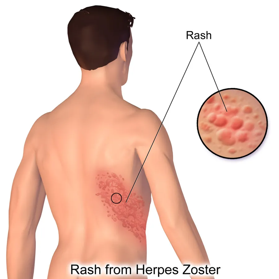 An illustration depicting a herpes zoster rash.
