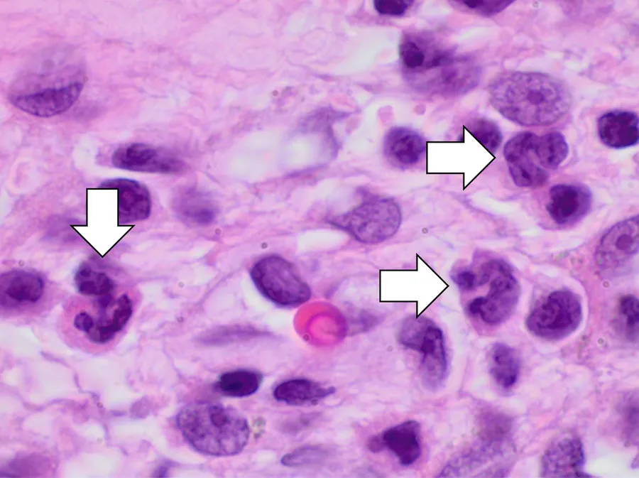 Histopathology of sinonasal acute inflammation, H&E stain, characterized by neutrophils (annotated by white arrows).