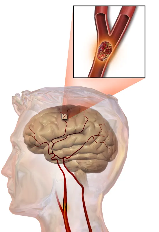 Stroke.