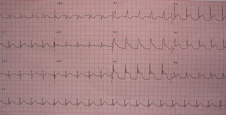 ST elevation in multiple leads in a person with a subarachnoid hemorrhage