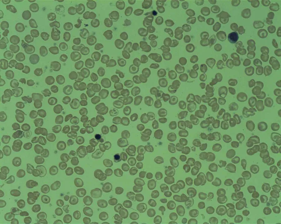 Peripheral Blood film from a patient with Delta Beta Thalassemia
