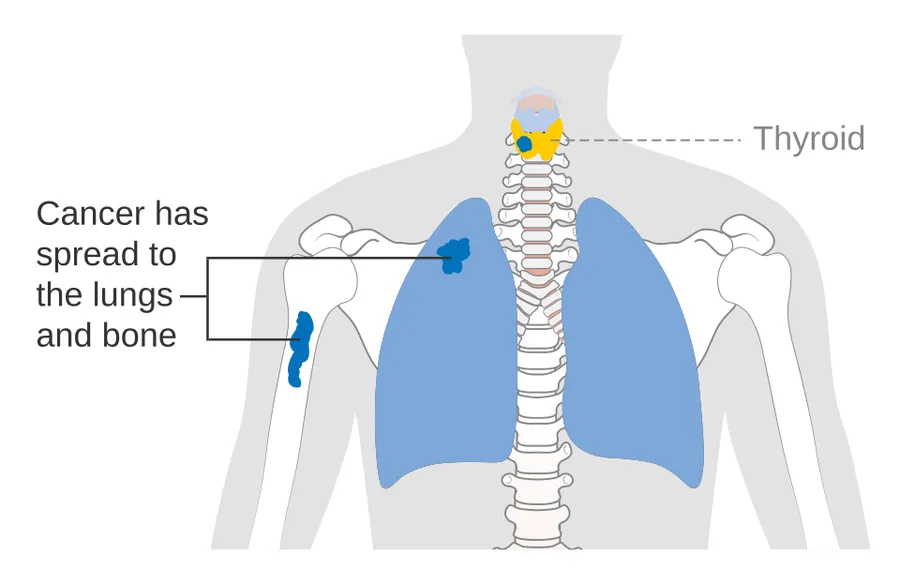 Diagram showing stage M1 thyroid cancer.